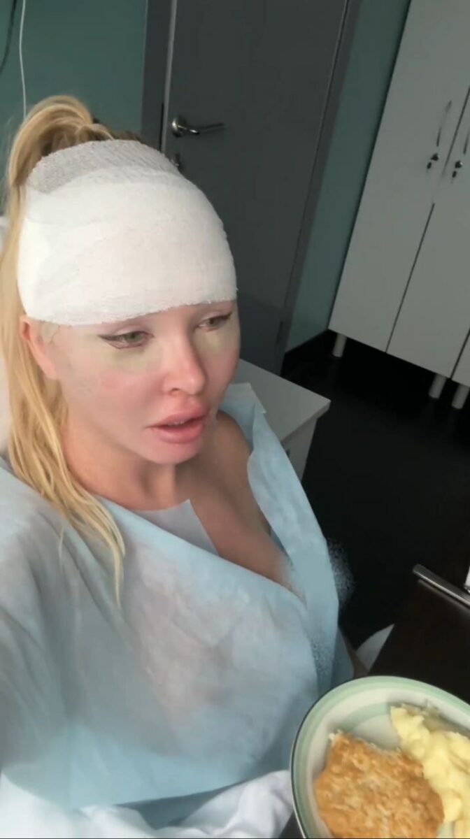 Дарья Пынзарь из «Дома-2» показала лицо сразу после пластики: «Ничего нигде не болит»